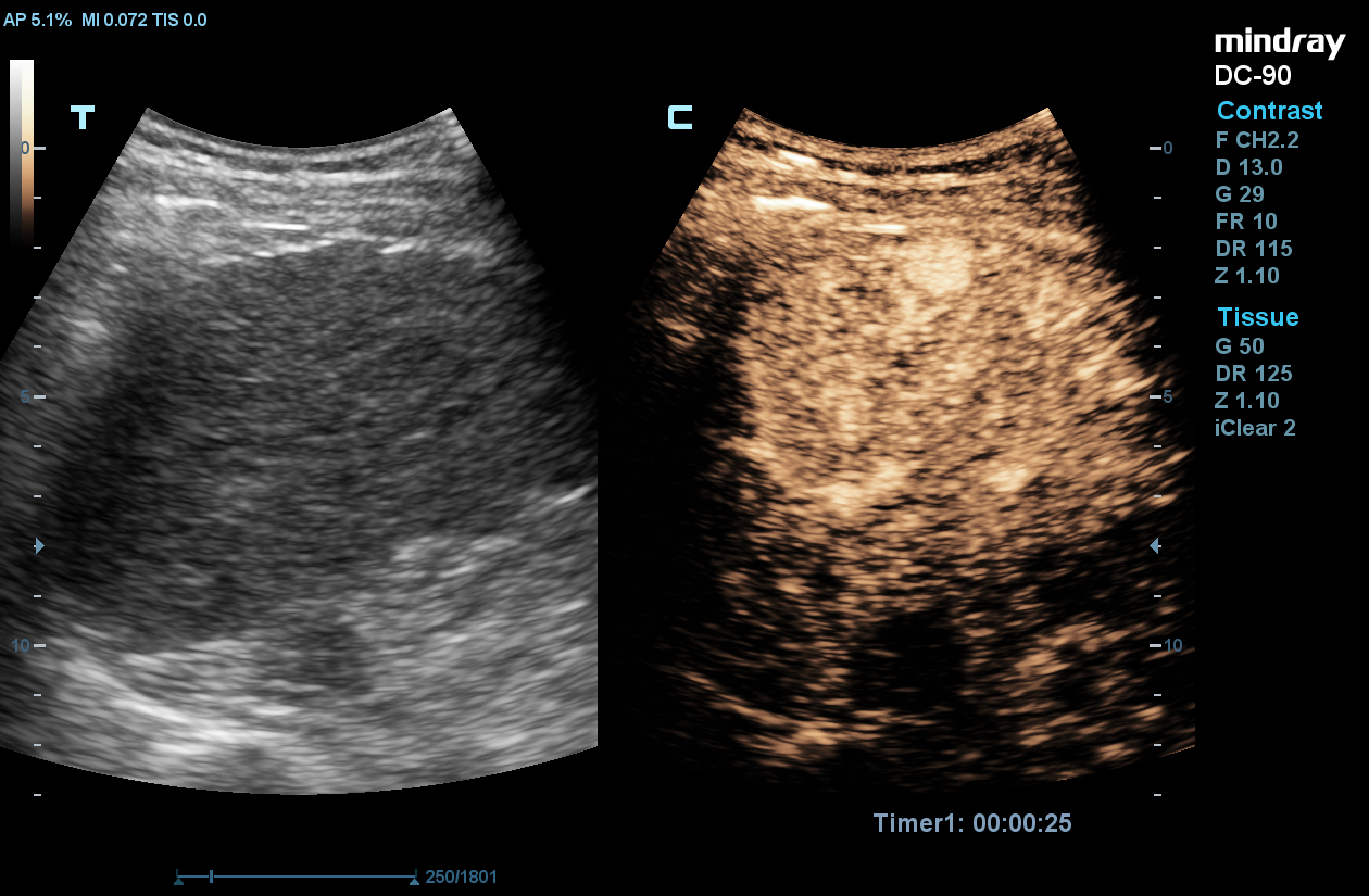 DC-90_abd_CEUS_liver_SC6-1E_001_web.jpg