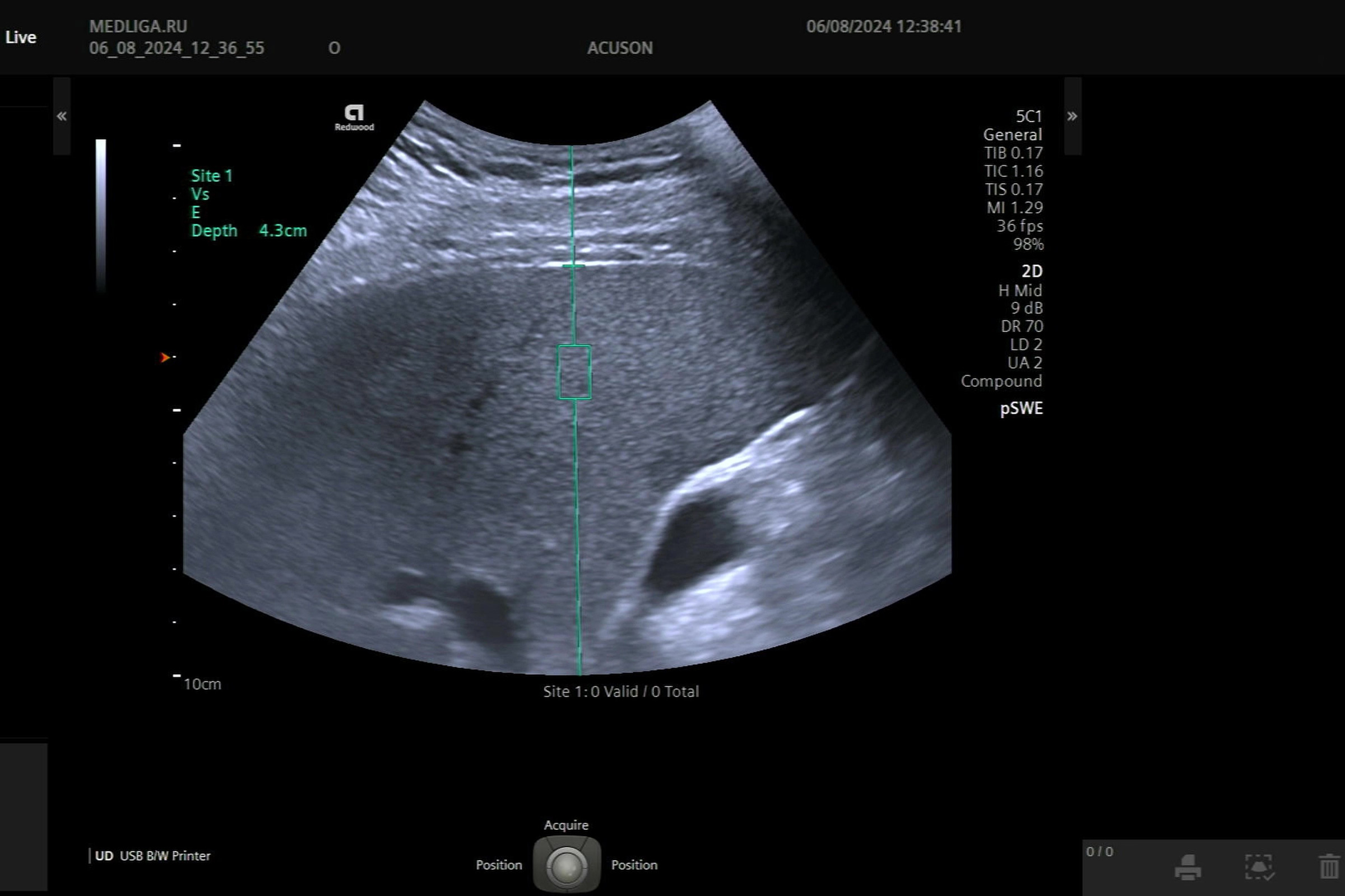 Техника проведения эластографии печени на Siemens Acuson Redwood