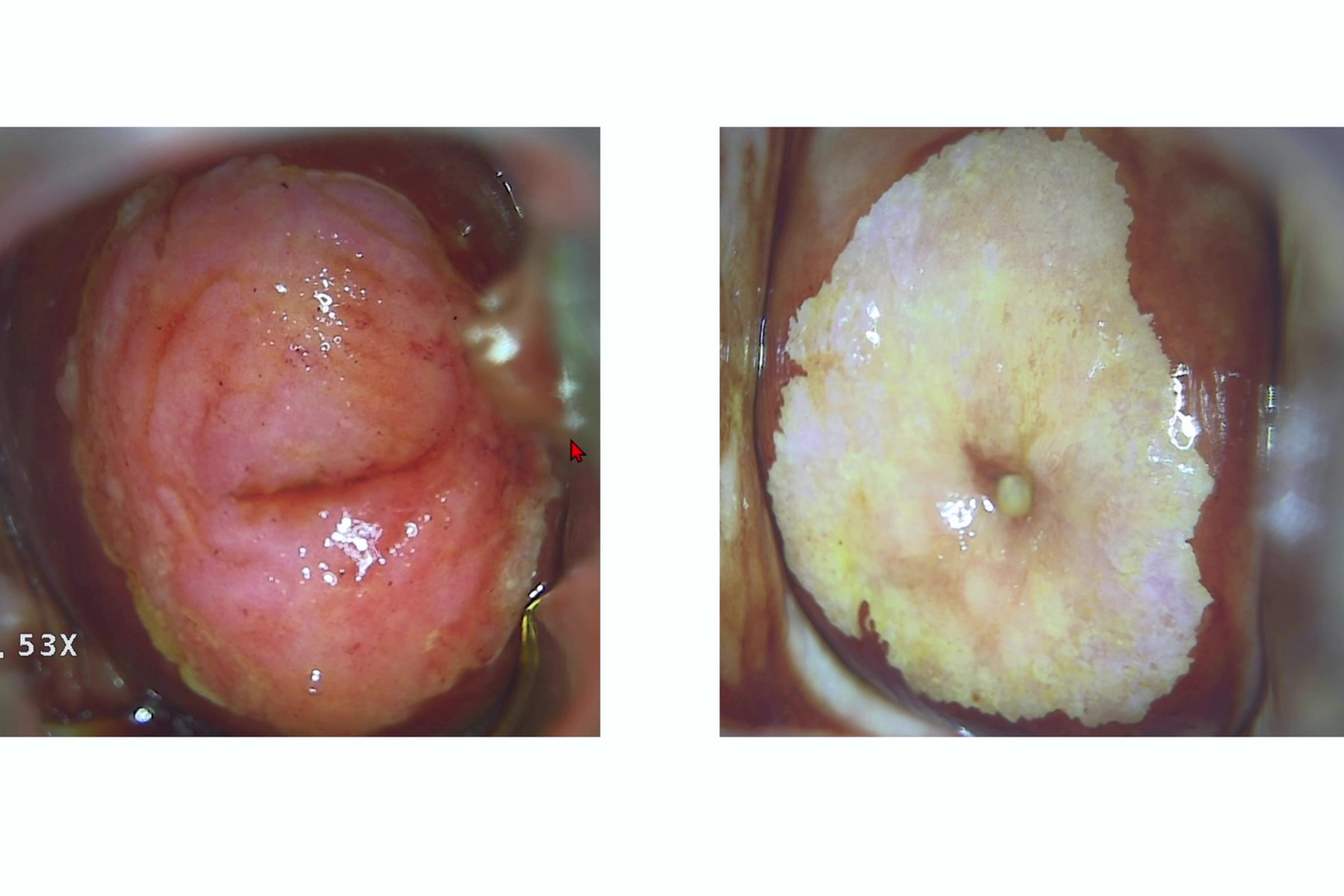 Как описать йоднегативную зону при кольпоскопии?