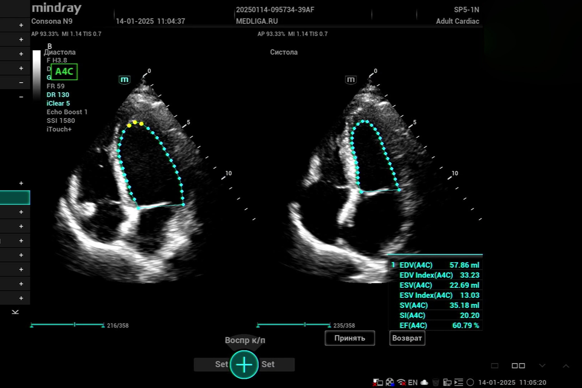 Возможности Mindray Consona N9 в эхокардиографии