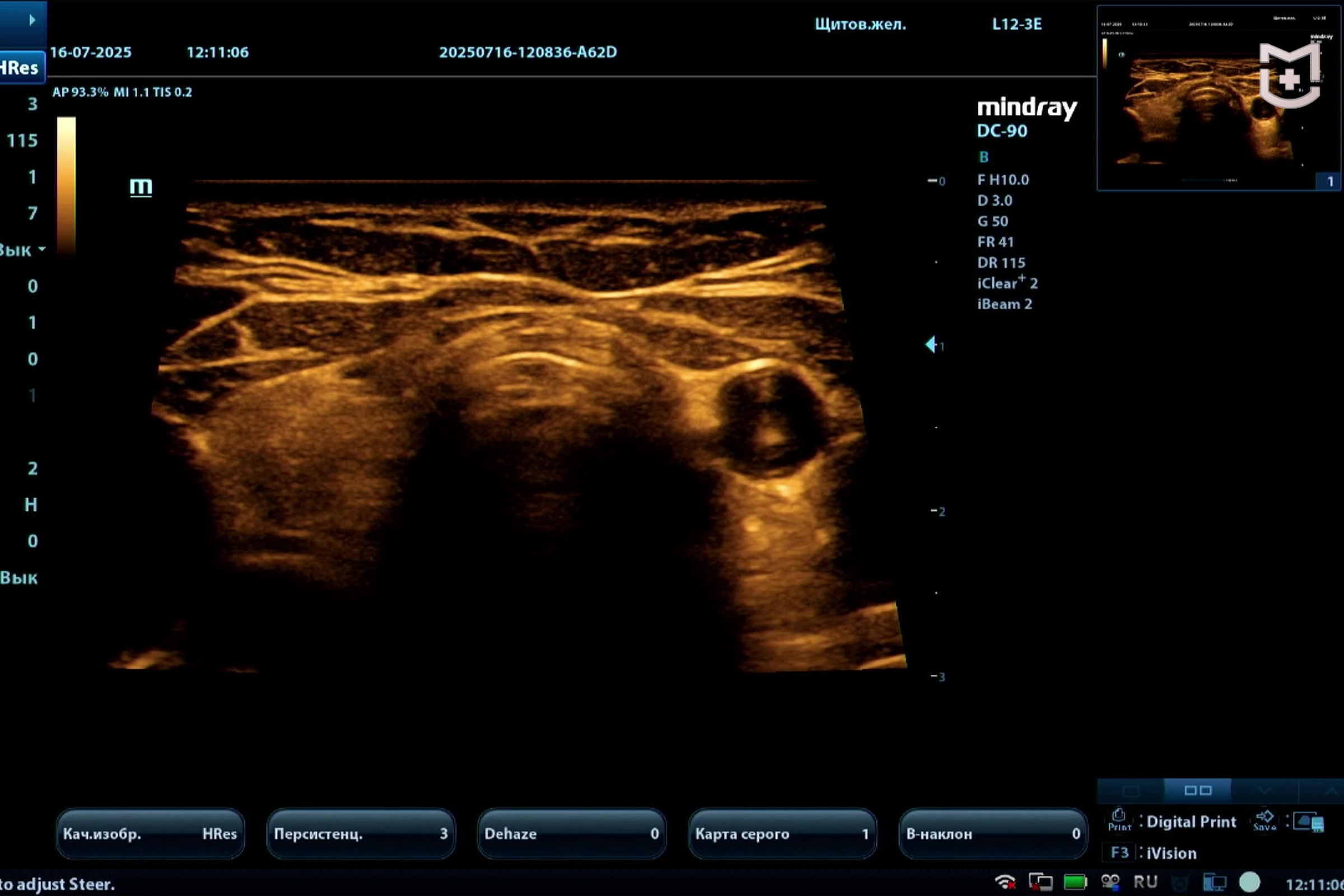 УЗИ щитовидной железы с удаленной левой долей: мастер-класс на Mindray DC-90