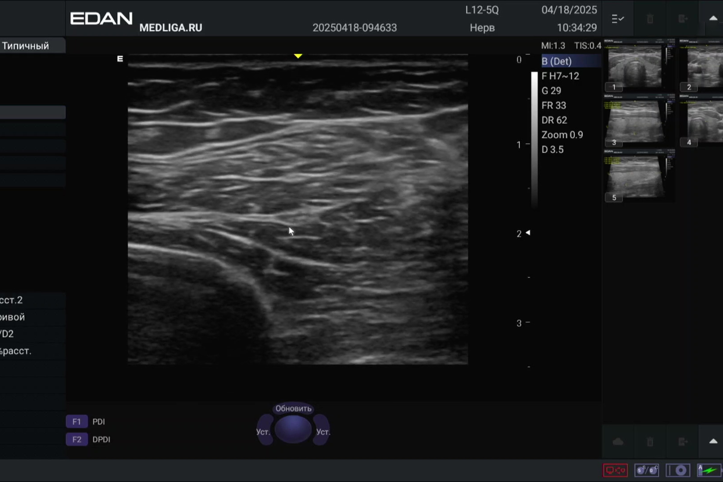Возможности EDAN Acclarix AX3: сканирование периферических нервов